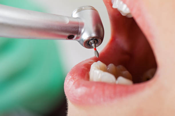 Best Emergency Treatment for Dental Infections or Abscesses in Pleasant Run, OH